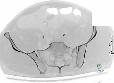 التعامل مع الأنسجة الرخوة بحذر