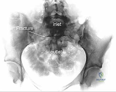 خطوات الفتح الجراحي الدقيق