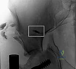 النتيجة النهائية للشق الجراحي