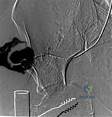 جراحة الرد المفتوح والتثبيت الداخلي لكسور الحوض والعجز: دليل المرضى الشامل مع الأستاذ الدكتور محمد هطيف في صنعاء