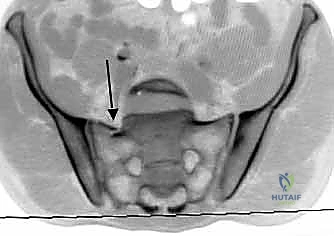 شريحة تيتانيوم لتثبيت الحوض