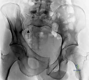 تحديد مسار الشق الجراحي