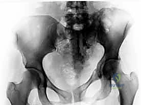 الوصول إلى منطقة الكسر