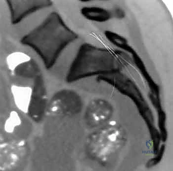 صورة مقطعية لكسر معقد في الحوض
