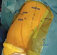 تثبيت الشريحة المعدنية بالمسامير