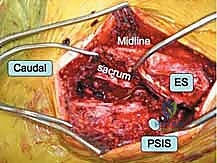 إدخال المسامير بدقة عالية