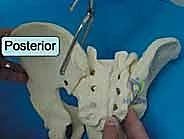 صورة طبية: جراحة الرد المفتوح والتثبيت الداخلي لكسور الحوض والعجز: دليل المرضى الشامل مع الأستاذ الدكتور محمد هطيف في صنعاء