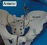 صورة طبية: جراحة الرد المفتوح والتثبيت الداخلي لكسور الحوض والعجز: دليل المرضى الشامل مع الأستاذ الدكتور محمد هطيف في صنعاء