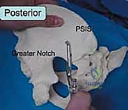 صورة طبية: جراحة الرد المفتوح والتثبيت الداخلي لكسور الحوض والعجز: دليل المرضى الشامل مع الأستاذ الدكتور محمد هطيف في صنعاء
