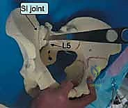 صورة طبية: جراحة الرد المفتوح والتثبيت الداخلي لكسور الحوض والعجز: دليل المرضى الشامل مع الأستاذ الدكتور محمد هطيف في صنعاء