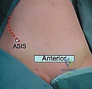 صورة طبية: جراحة الرد المفتوح والتثبيت الداخلي لكسور الحوض والعجز: دليل المرضى الشامل مع الأستاذ الدكتور محمد هطيف في صنعاء