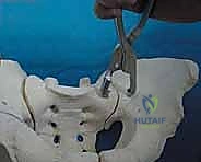 صورة طبية: جراحة الرد المفتوح والتثبيت الداخلي لكسور الحوض والعجز: دليل المرضى الشامل مع الأستاذ الدكتور محمد هطيف في صنعاء