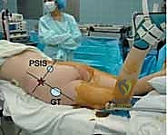 عملية رد العظام إلى مكانها