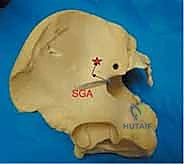 صورة توضيحية لـ جراحة الرد المفتوح والتثبيت الداخلي لكسور الحوض والعجز: دليل المرضى الشامل مع الأستاذ الدكتور محمد هطيف في صنعاء