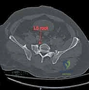 صورة طبية: جراحة الرد المفتوح والتثبيت الداخلي لكسور الحوض والعجز: دليل المرضى الشامل مع الأستاذ الدكتور محمد هطيف في صنعاء