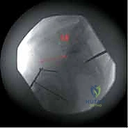 Intraoperative Surgical Step