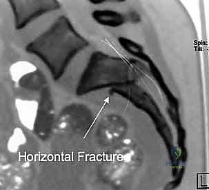 استخدام الملاقط العظمية المتخصصة