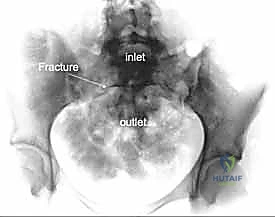 صورة طبية: جراحة الرد المفتوح والتثبيت الداخلي لكسور الحوض والعجز: دليل المرضى الشامل مع الأستاذ الدكتور محمد هطيف في صنعاء