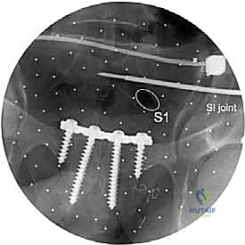 صورة توضيحية لـ جراحة الرد المفتوح والتثبيت الداخلي لكسور الحوض والعجز: دليل المرضى الشامل مع الأستاذ الدكتور محمد هطيف في صنعاء