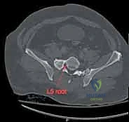 تصوير شعاعي يوضح شدة الكسر