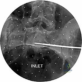 تجهيز أدوات التثبيت الداخلي