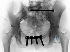 صورة توضيحية لـ جراحة الرد المفتوح والتثبيت الداخلي لكسور الحوض والعجز: دليل المرضى الشامل مع الأستاذ الدكتور محمد هطيف في صنعاء