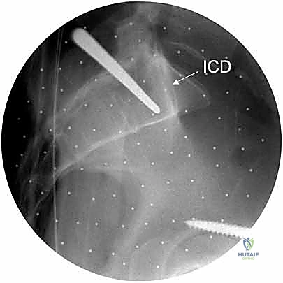 صورة شعاعية تؤكد نجاح التثبيت