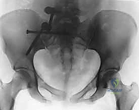 Illustration of spinal pelvic fixation - Dr. Mohammed Hutaif