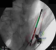 صورة توضيحية لـ جراحة الرد المفتوح والتثبيت الداخلي لكسور الحوض والعجز: دليل المرضى الشامل مع الأستاذ الدكتور محمد هطيف في صنعاء