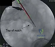 صورة طبية: جراحة الرد المفتوح والتثبيت الداخلي لكسور الحوض والعجز: دليل المرضى الشامل مع الأستاذ الدكتور محمد هطيف في صنعاء