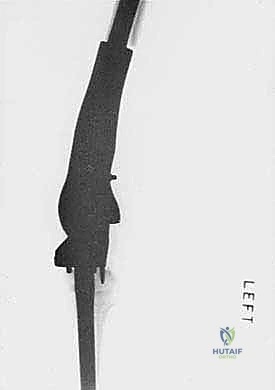 مقارنة شعاعية بين طرف طبيعي وطرف تم إعادة بنائه