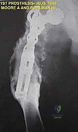 صورة توضح ورم عظمي غضروفي في عظم الفخذ البعيد تم علاجه بالدوكسوروبيسين قبل الاستئصال الجراحي.