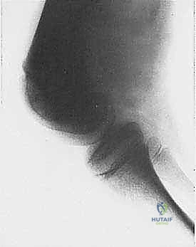 صورة توضيحية لـ إعادة بناء الأطراف الاصطناعية الداخلية: أمل جديد لمرضى أورام العظام مع الأستاذ الدكتور محمد هطيف