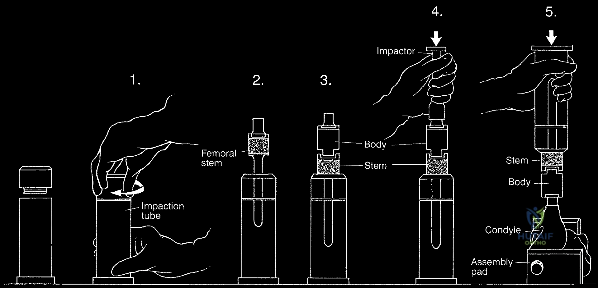 صورة طبية: إعادة بناء الأطراف الاصطناعية الداخلية: أمل جديد لمرضى أورام العظام مع الأستاذ الدكتور محمد هطيف