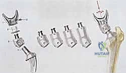 صورة توضيحية لـ إعادة بناء الأطراف الاصطناعية الداخلية: أمل جديد لمرضى أورام العظام مع الأستاذ الدكتور محمد هطيف