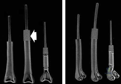 صورة طبية: إعادة بناء الأطراف الاصطناعية الداخلية: أمل جديد لمرضى أورام العظام مع الأستاذ الدكتور محمد هطيف