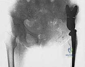 تشريح دقيق لعظم الفخذ ومفصل الركبة