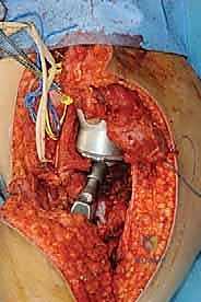 أشعة سينية تظهر تدمير القشرة العظمية بسبب الورم