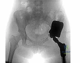 صورة مقطعية CT scan توضح تفاصيل التدمير العظمي