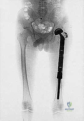 صورة رنين مغناطيسي توضح امتداد ورم الساركوما العظمية