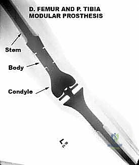 عملية استئصال الورم بكتلة واحدة مع الحفاظ على الأنسجة المحيطة