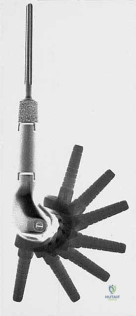 صورة شعاعية لطرف اصطناعي قابل للتمدد عند طفل