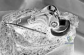 استخدام الأسمنت العظمي لتثبيت الساق داخل القناة النخاعية