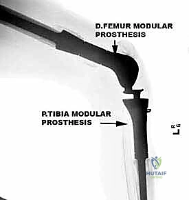تجميع وتثبيت الطرف الاصطناعي الداخلي في غرفة العمليات