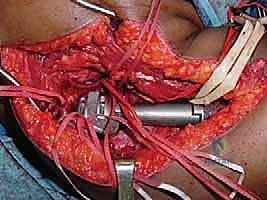صورة طبية: إعادة بناء الأطراف الاصطناعية الداخلية: أمل جديد لمرضى أورام العظام مع الأستاذ الدكتور محمد هطيف