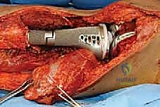 صورة طبية: إعادة بناء الأطراف الاصطناعية الداخلية: أمل جديد لمرضى أورام العظام مع الأستاذ الدكتور محمد هطيف