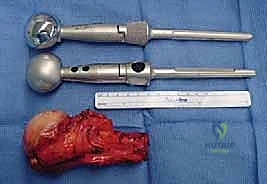 صورة طبية: إعادة بناء الأطراف الاصطناعية الداخلية: أمل جديد لمرضى أورام العظام مع الأستاذ الدكتور محمد هطيف