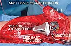 إغلاق الجرح بعناية فائقة بعد الانتهاء من التغطية النسيجية