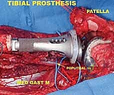 صورة توضيحية لـ إعادة بناء الأطراف الاصطناعية الداخلية: أمل جديد لمرضى أورام العظام مع الأستاذ الدكتور محمد هطيف