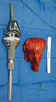 صورة طبية: إعادة بناء الأطراف الاصطناعية الداخلية: أمل جديد لمرضى أورام العظام مع الأستاذ الدكتور محمد هطيف